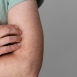 Sarampión: primer caso autóctono en hombre de 28 años en San Javier