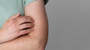 Sarampión: primer caso autóctono en hombre de 28 años en San Javier