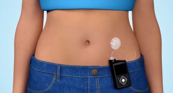 FNR incorporó bomba parche de insulina para diabéticos